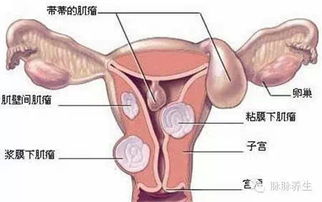 为什么子宫肌瘤千万不要手术，割了子宫会后悔的。你认同吗