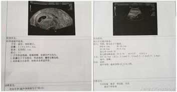 教您看懂产科超声报告 