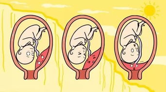 孕晚期阴道出血怎么回事