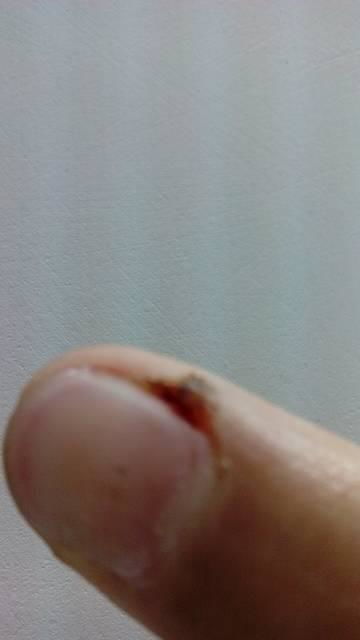 右手食指指甲旁边有个伤口一样的东西就像长了一团肉 