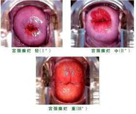 未婚就宫颈糜烂三度了，是否可以做电击手术？如果做了手术会对以后生育有影响吗？