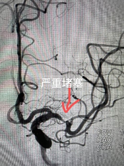 3个月内连发两次脑梗 微米级微创畅通颅内血管 