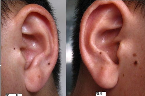 耳朵上的痣代表什么 