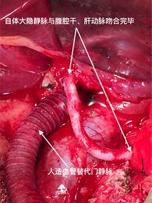 腹腔干 门静脉受侵胰腺癌联合动静脉切除