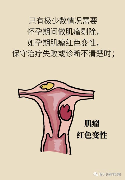 怀孕后发现子宫肌瘤怎么办