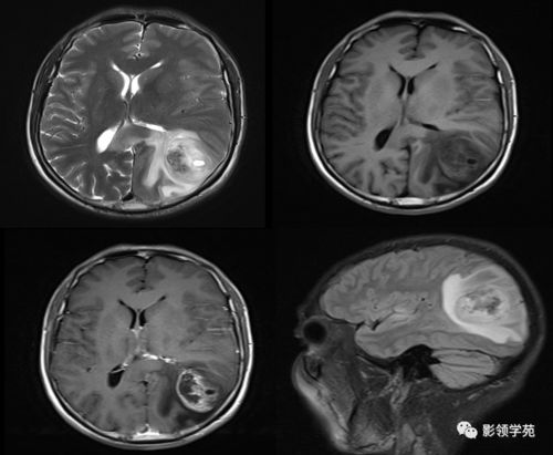 大脑胶质瘤病影像学诊断