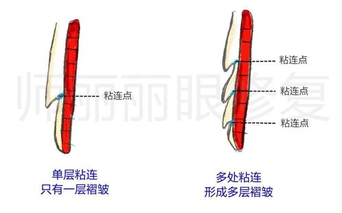 师丽丽眼修复丨双眼皮多层褶 多层眼皮可以进行修复吗 效果怎么样