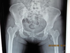 左侧耻骨下肢骨折图片 搜狗图片搜索