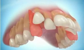 牙齿矫正需经历哪些过程