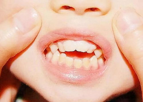 孩子牙齿 地包天 ,能不能矫正恢复呢