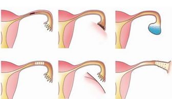 输卵 输卵堵塞的症状