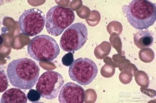 血液病淋巴瘤能活多久，细胞淋巴癌跟白血病哪个严重