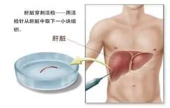 瘦子也会得脂肪肝,后果可能会比胖子还严重 