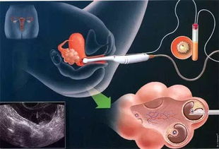 卵巢位置异常导致不孕是否能直接去做试管婴儿助孕？