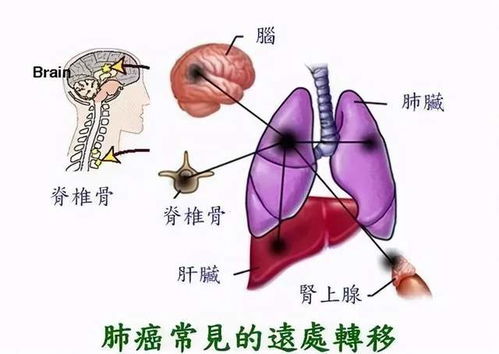 TP53和KRAS共突变脑寡转移性肺癌,经免疫化疗和手术切除后获得完全缓解