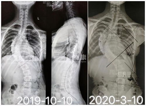 14岁女孩84 脊柱侧弯,是保守治疗还是手术