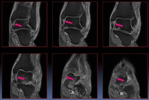 踝关节常见病变MRI表现全总结