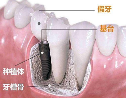 关于种植牙知识,你想知道都在这里了 听种植专家黄博士为您解答