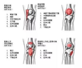 膝盖肌腱炎的症状图片 搜狗图片搜索