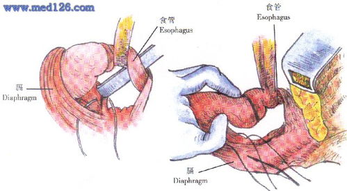 食管裂孔疝修补术操作步骤,图片图谱图解,手术治疗方法,诊断食管手术 