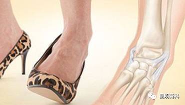 骨科专家教你如何正确处理崴脚 踝关节扭伤 