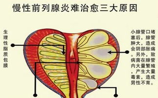 慢性前列腺炎是什么病