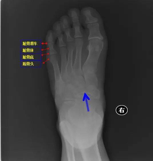 左脚三 四跖骨骨折和右侧跟骨骨折 图片欣赏中心 急不急图文 Jpjww Com