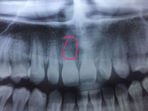 牙根断？牙齿牙根断裂怎么办