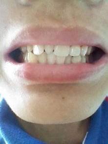 门牙左边长了一颗尖牙导致左边门牙倾斜 还有左边的虎牙已经拔掉 能不能矫正 