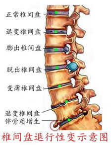 搜狐公众平台 腰椎间盘突出真的可以有效的根治吗 