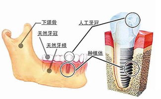 做过种植牙,还可以做正畸吗 