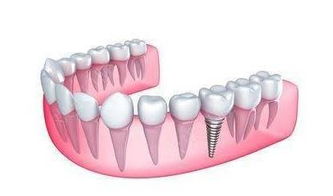 江阴哪家种植牙好