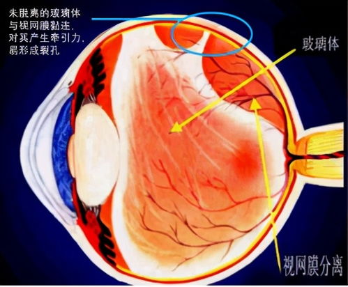 玻璃体后脱离手术有哪些风险？