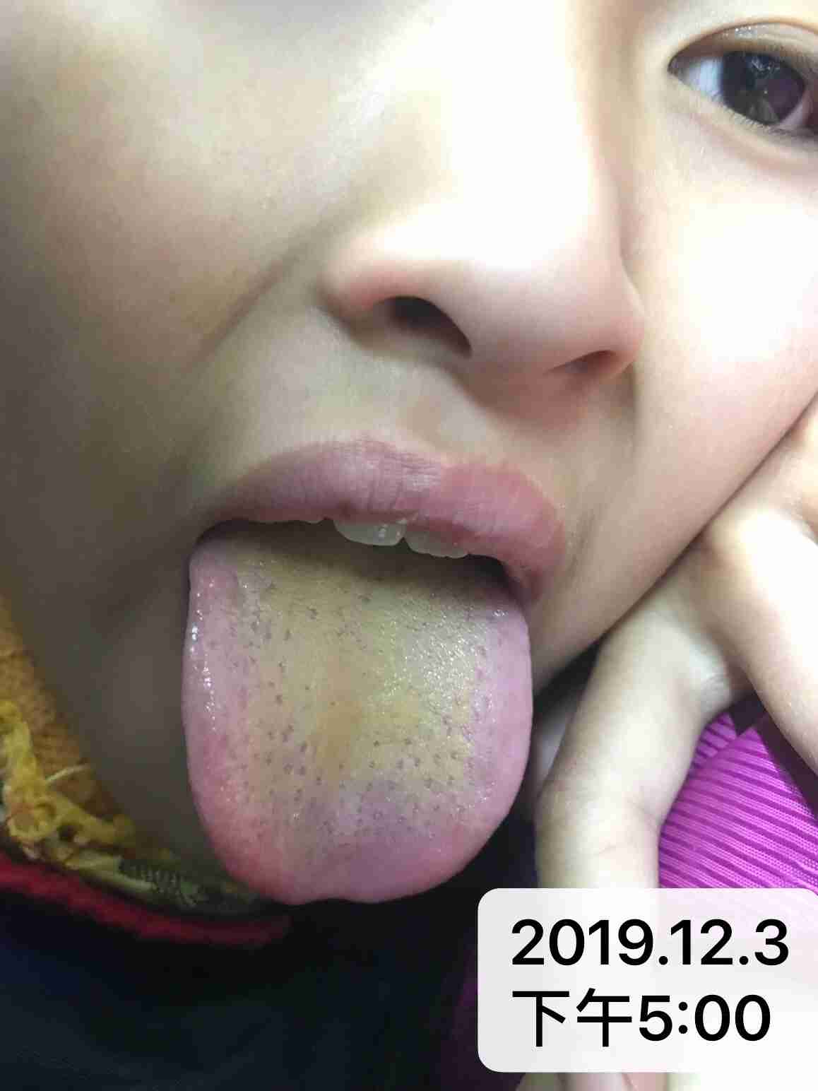 哪位大神帮我看一下这个舌苔,发烧第四天了,谢谢 