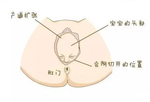 准妈咪的痛 顺产时会阴该不该侧切 如果不幸被切,该如何护理好伤口 