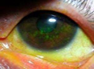 角膜炎图片初期 眼睛角膜炎用什么药比较好？ 