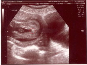 怀孕10周做胎儿盆腔B超，听不到原始心管搏动是怎么回事(怀孕10周做b超没有胎心正常吗)