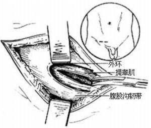 斜疝手术 腹股沟斜疝手术需切开哪些层次