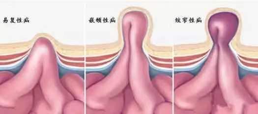 疝气 是气 太天真了