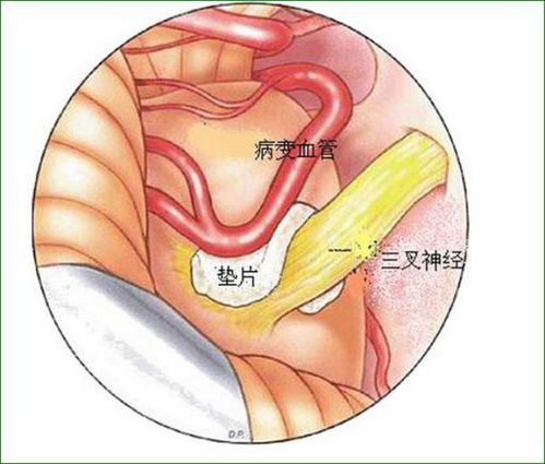 三叉神经痛手术会对神经造成损伤吗