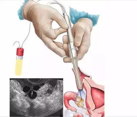 试管备孕为什么最好提前切除积水的输卵管？