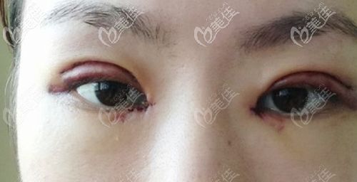 割双眼皮三个月上眼皮发黑能自行恢复吗 需要修复吗