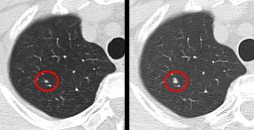 查出肺部小结节没在意,两年后癌细胞转移了 什么样的肺结节要重视