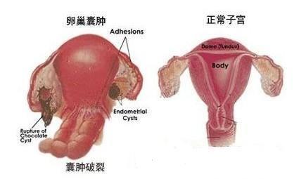 少女体内长10斤重巨型卵巢囊肿