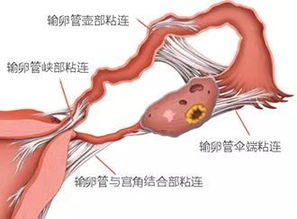 输卵管粘连可以怀孕吗 你了解背后原因吗