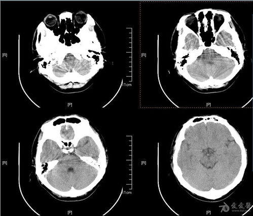 帮忙看看脑外伤后头颅CT