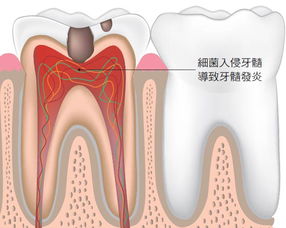 牙疼一定是牙髓炎,牙齿有龋齿一定会得牙髓炎吗?牙髓炎症状
