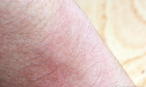 这3类疾病,都会引起皮肤瘙痒 不只是皮肤病那么简单