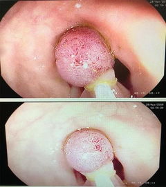 胃肠道息肉都是癌前病变吗