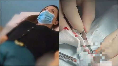 TVB知名女星拔倒刺住院,手指红肿还流血,医生建议 莫乱拔,有人曾被截肢 